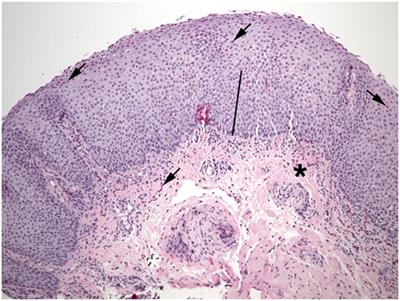 Eosinophilic Gastrointestinal Disorders Pathology